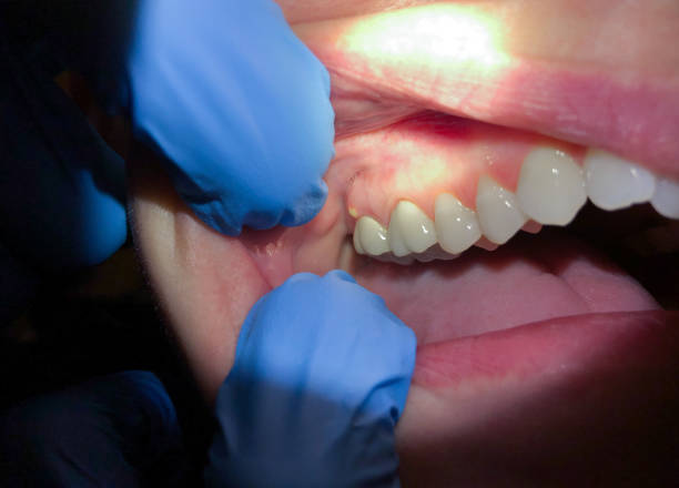 Best Emergency Treatment for Dental Infections or Abscesses in Orange Cove, CA