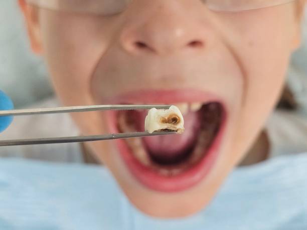 Best Emergency Wisdom Teeth Removal in Orange Cove, CA